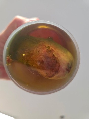 Gallbladder specimen in a container after surgery