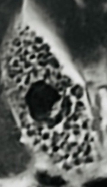 Zoomed image of gallbladder stones on imaging