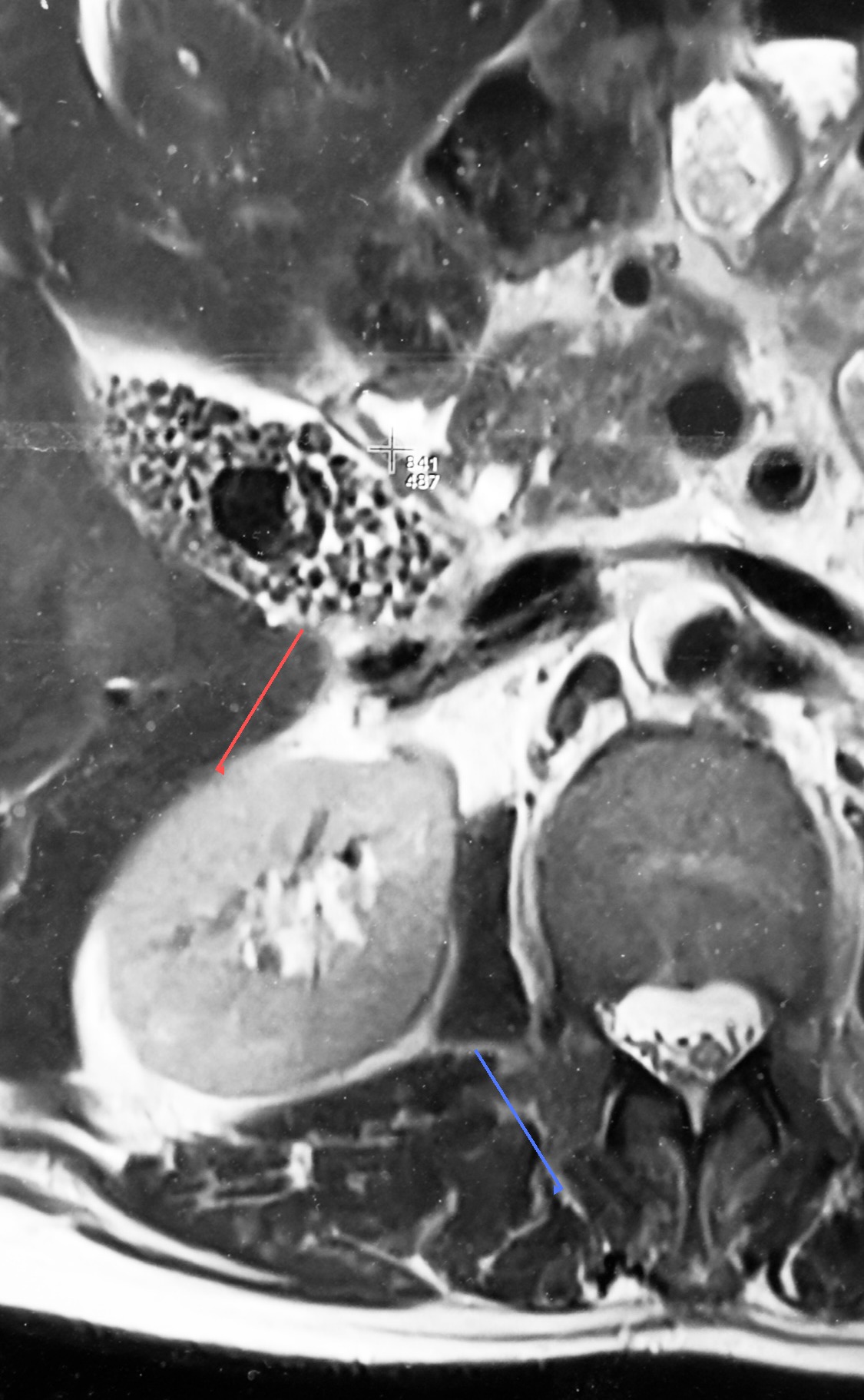 MRI scan showing gallbladder packed with gallstones (illustrative)