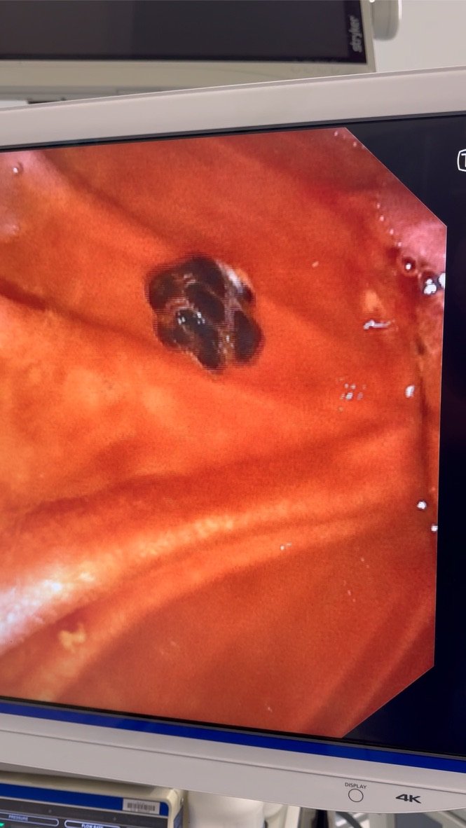 Laparoscopic view showing gallstones
