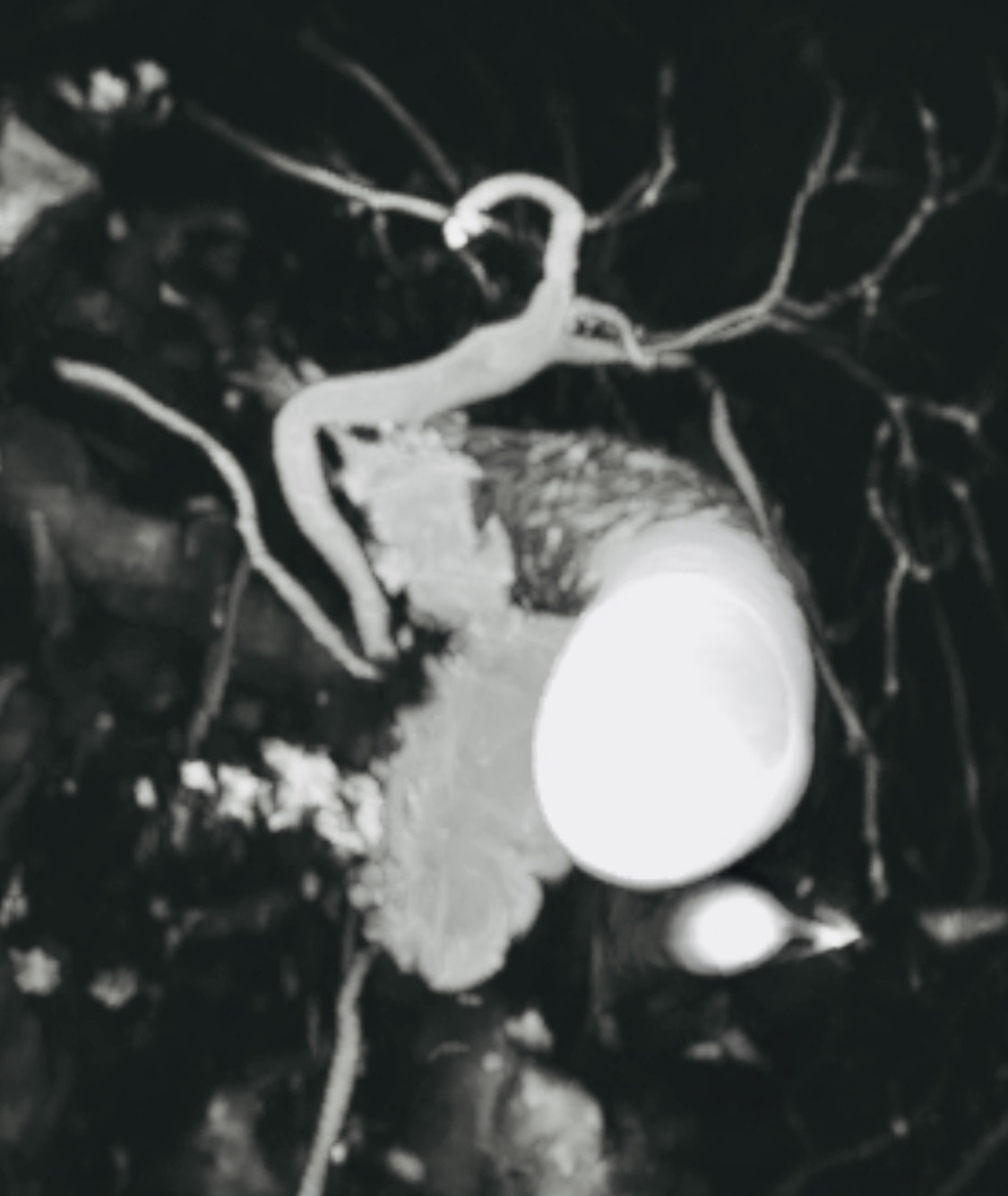 MRCP (MRI of bile ducts) example image (illustrative)