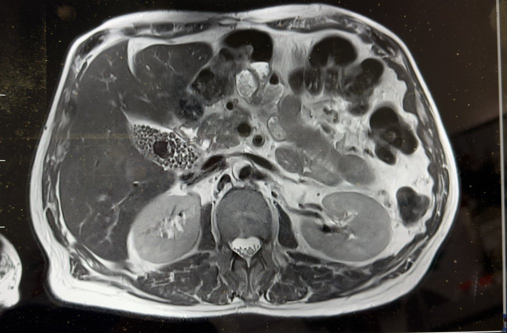 MRI axial slice showing gallbladder filled with multiple stones